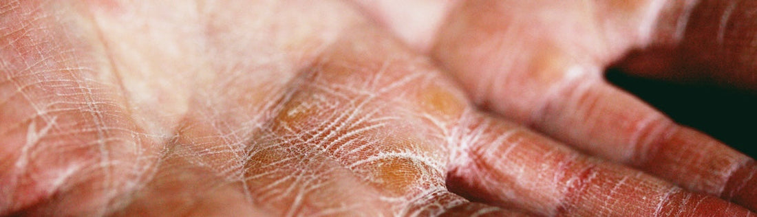 How cholesterol-lowering medications and precision medicine improve psoriasis treatment