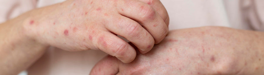Medication hypersensitivity: genetics and drug toxicity